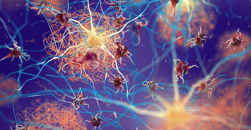 Amyloid plaques forming between neurons 3d ilustration. Beta-amyloid protein disrupting nerve cells function in a brain with Alzheimer's disease